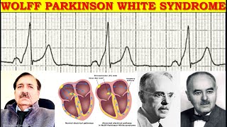 Arrhythmias associated with Wolff Parkinson White Syndrome  Lectures by Dr Alamzeb [upl. by Aivatco401]