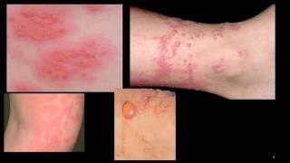 Contact Dermatitis [upl. by Nirad]