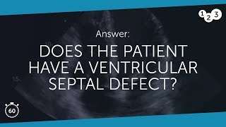 60 Seconds of Echo Teaching Answer Ventricular Septal Defect [upl. by Patten]