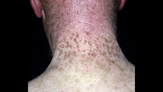 The Language of Dermatology Part I Plus Nevus Flammeus Lentigo Ephelides freckles and Melasma [upl. by Isabel]