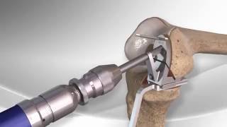 Partial Knee Replacement with the Arthrex® iBalance® UKA [upl. by Campney]