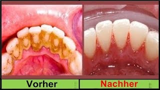 KEIN SCHERZ Entferne deinen Zahnbelag in 2 Minuten ohne zum Zahnarzt zu gehen [upl. by Ok]