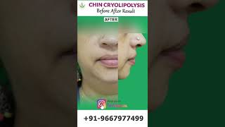 Chin Transformation with Cryolipolysis Before and After Results  Care Well Medical Centre shorts [upl. by Claman]