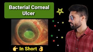 Bacterial corneal ulcer lecture opthalmology [upl. by Raasch]