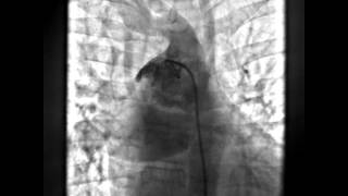 Non Confluent Pulmonary Arteries [upl. by Salba]