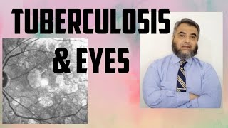 TUBERCULOSIS AND EYES Tuberculosis EyeinfectionRifampicinisoniazidethambutol [upl. by Orlina]