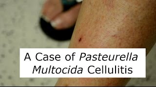 P Multocida Cat Scratch Infection [upl. by Noraha]