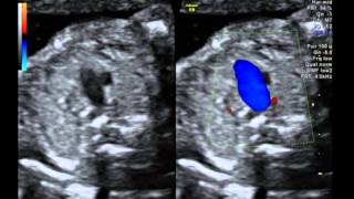 Tetralogy of Fallot with pulmonary atresia [upl. by Rj]