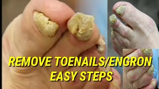 REMOVE TEONAILSENGRON EASY STEPS🤪 [upl. by Zaneta49]