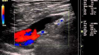 ArterioVenous Fistula DVT AVF arteriovenous [upl. by Iaverne575]