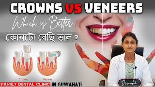 CROWNS VS VENEERS  Which is best  Dr Sanchita Kalita [upl. by Omland]