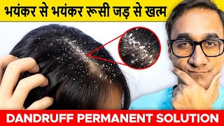 भयंकर से भयंकर रूसी जड़ से खत्म  How to get rid of Dandruff  Dandruff Treatment at Home [upl. by Lesak369]