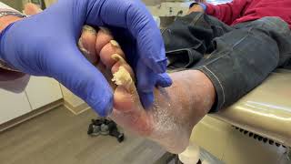 Unbelievable long painful toenails part 2 [upl. by Derfniw]