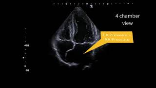 Atrial septal aneurysm [upl. by Ernald21]