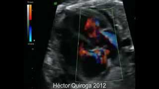 Taquicardia supraventricular fetal antes y después del tratamiento [upl. by Eloc]