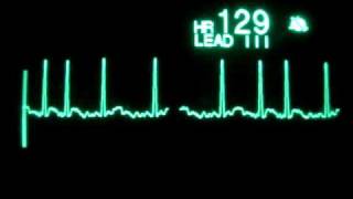 Atrial Fibrillation with RVR [upl. by Petronella978]