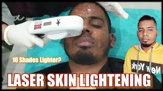 Laser skin lightening10 Shades Lighter I tried laser skin brightening [upl. by Ammadas904]