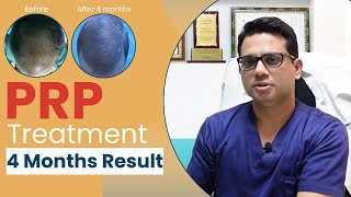 PRP treatment results after 4 months  PRP for hair growth in Delhi  Hair transplant in Delhi [upl. by Trici]