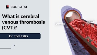 What is cerebral venous sinus thrombosis CVST [upl. by Anastasius307]