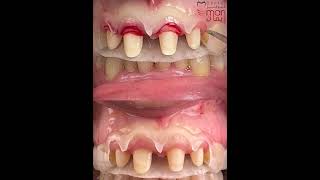 Surgical guide for gingiva Tommy and gingiviplasty [upl. by Lokin]