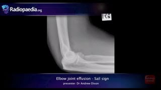 Elbow joint effusion and the sail sign  radiology video tutorial xray [upl. by Christabella579]