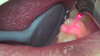 Tooth Restoration  Class 1  Waterlase Laser Dentistry Restorative Dentistry [upl. by Snehpets]