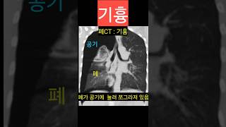 기흉 엑스레이 CT 진단 pneumothorax lung air [upl. by Tomasina]