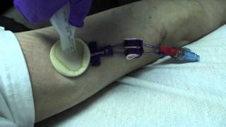 Roughest Picc Line Removal Ever  HD [upl. by Monica]