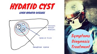 Hydatid Cyst [upl. by Maridel]