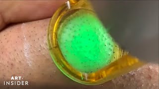 Laser Zaps Out Ingrown Hairs  Art Insider [upl. by Aytnahs]