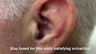 Ear Blackhead Extraction  Dr Steven Greene in Seattle [upl. by Asiilanna907]