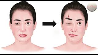 Treatment of Hemifacial Spasm amp Benign Essential Spasm with Botulinum Toxin Injections in India [upl. by Atinid]