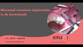 Implantaat implantatie in de kaak [upl. by Phelgen]