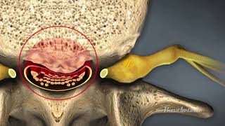 Spinal Stenosis Causes and Treatment [upl. by Artenal]