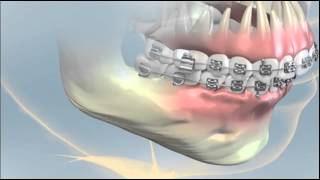 Orthognathic Surgery NYC [upl. by Dennett115]