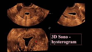 The Endometrium ultrasound [upl. by Gord57]