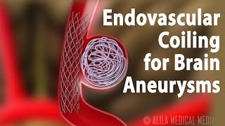 Endovascular Coiling for Brain Aneurysm Animation [upl. by Epolulot]