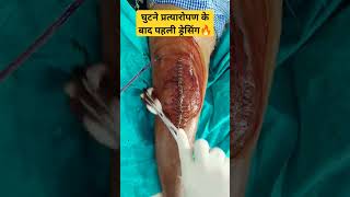 Knee Replacement 1st Dressing ☑️ घुटने के जोड़ बदलने के बाद पहली ड्रेसिंग [upl. by Royal]