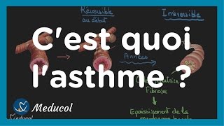 Lasthme cest quoi physiopathologie causes symptômes et traitement [upl. by Cohbath871]