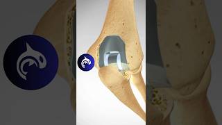 Total Elbow Replacement TER anatomy elbow surgery [upl. by Kalila827]