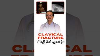 Clavical Fracture  Clavical Fracture में हड्डी कैसी जुड़ती है ।  Collar Bone Fracture in Children [upl. by Milak]