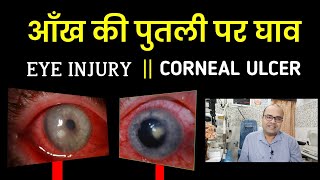 आँख की पुतली पर घाव या जख्म  Ulcer on the Cornea due to injury  Keratitis [upl. by La Verne917]