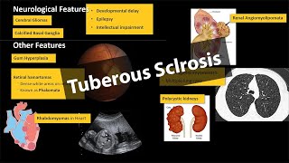 Tuberous Sclerosis  Pathology amp Clinical Features WITH PHOTOS [upl. by Ytsirk697]