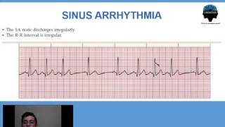 4 Arritmia Sinusal Respiratoria [upl. by Amliv485]