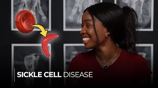 Sickle Cell Disease Understanding the Causes Symptoms and Sickle Cell Crisis [upl. by Dnalsor]