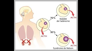 Anesthésie pour chirurgie surrenalienne  Cours [upl. by Airres]