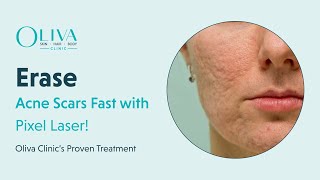 Erase Acne Scars Fast with Pixel Laser  Oliva Clinic’s Proven Treatment [upl. by Filia64]