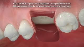 Straumann® BLX Conventional Molar Placement [upl. by Orvas113]