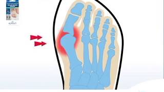 How to Correct an Hallux Valgus and Relieve Bunion Pain  EPITACT at Boots [upl. by Fermin]