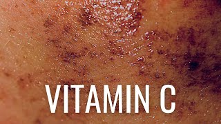 HOW Vitamin C PREVENTS Hyperpigmentation [upl. by Yenahs]